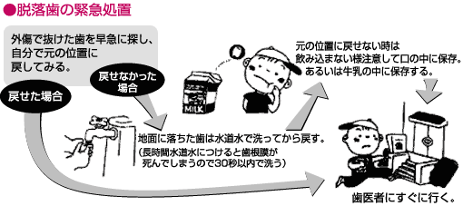 脱落歯の応急措置